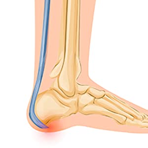 Improve heel pain