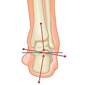 Relieve plantar fasciitis