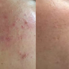 dermapen