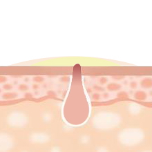 The first stage of acne after use