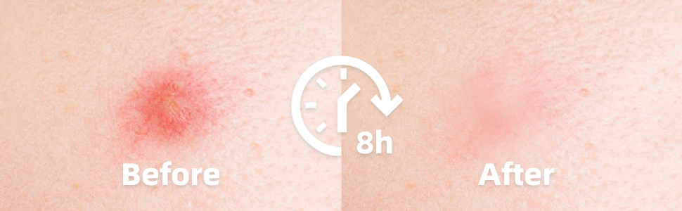 The third stage of acne after use