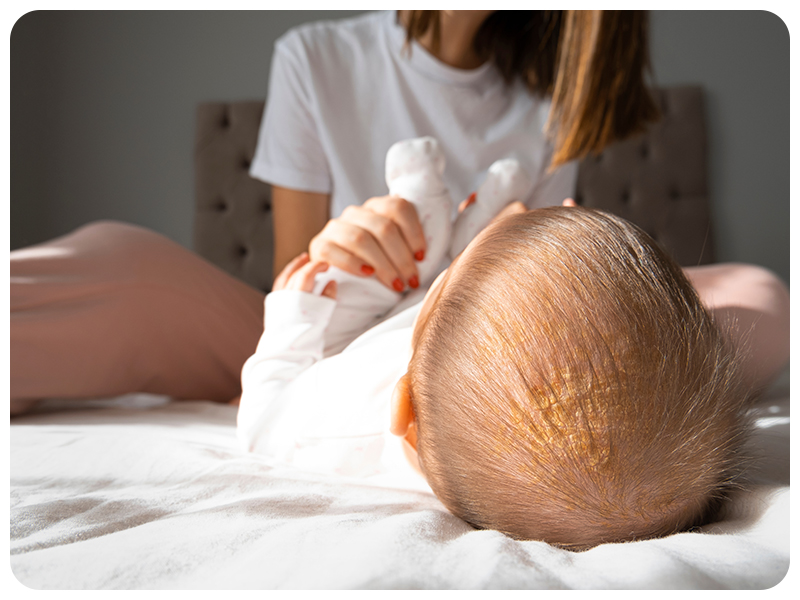 baby with cradle cap before use of baby head scrubber for cradle cap